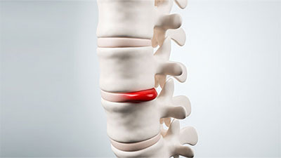 patient needs herniated disc chiropractor in Sacramento, CA
