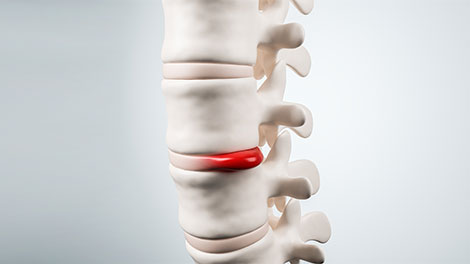 patient requiring disc injury treatment in Sacramento