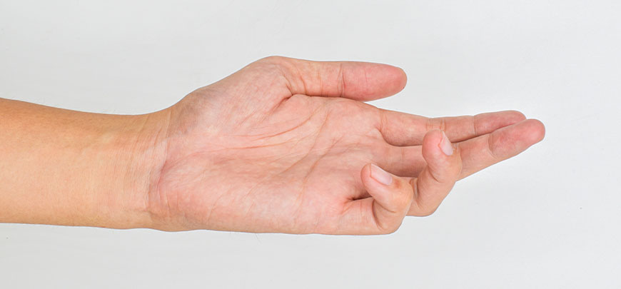 patient needing dupuytren contracture treatment in Sacramento