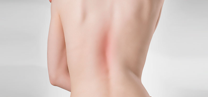 patient needing scoliosis treatment in Sacramento