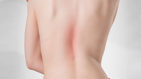 patient requiring scoliosis treatment in Sacramento