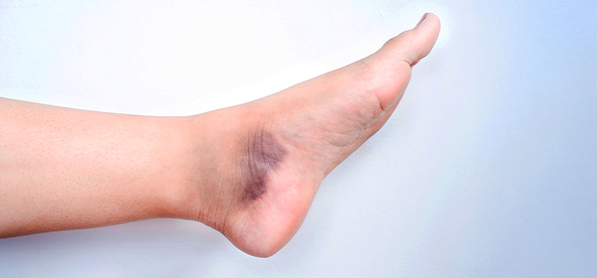 patient needing sprain treatment in Sacramento