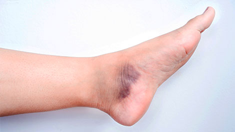 patient requiring sprain treatment in Sacramento