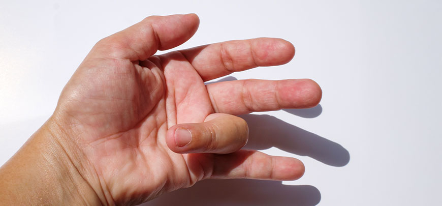 patient needing trigger finger treatment in Sacramento